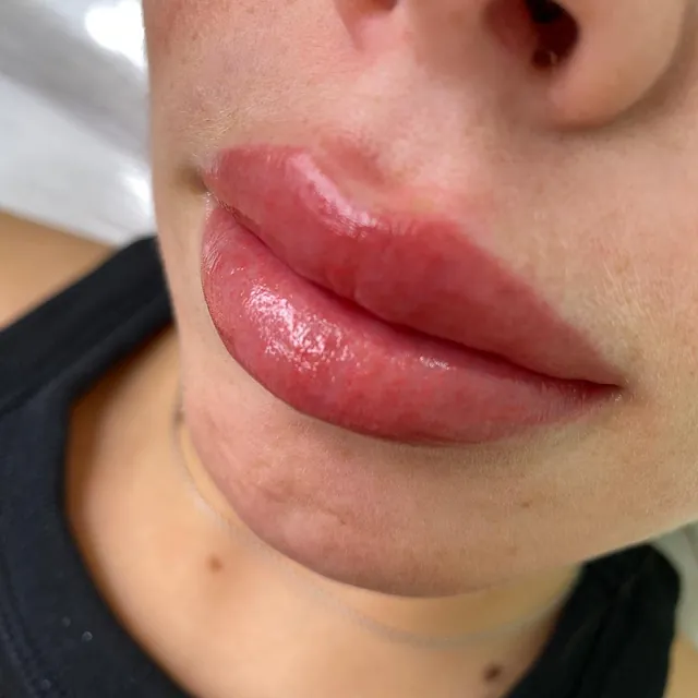 tratamiento labios