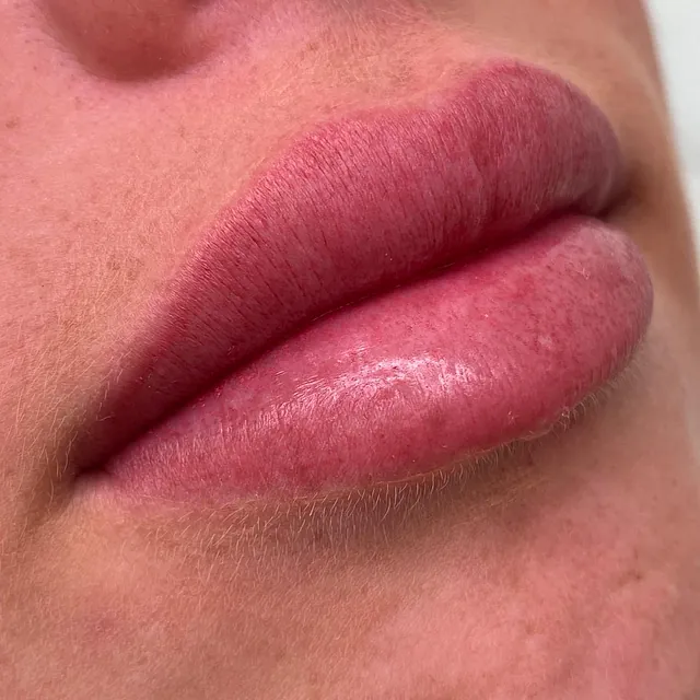 tratamiento labios